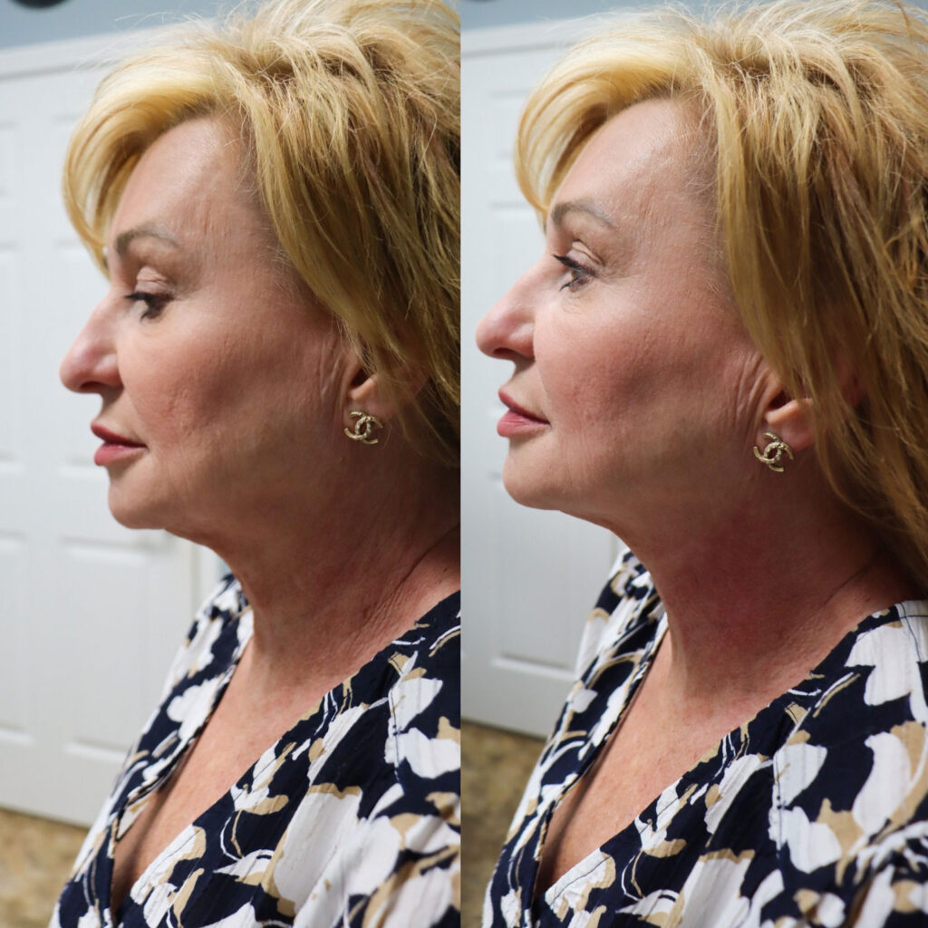 Bellafill Treatment Areas: What Can We Improve?