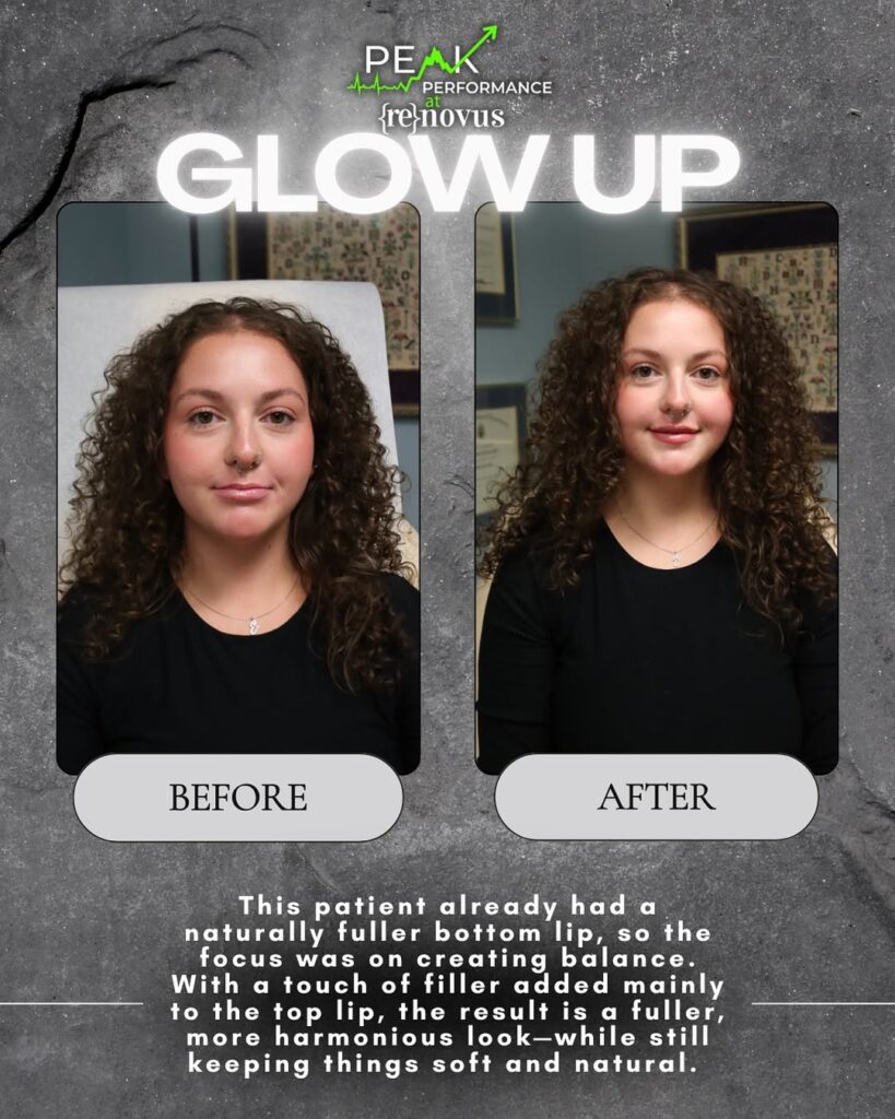 Before and after results of lip filler in Johnson City at Peak Performance. Subtle filler added to the top lip created a fuller, balanced, and natural look.