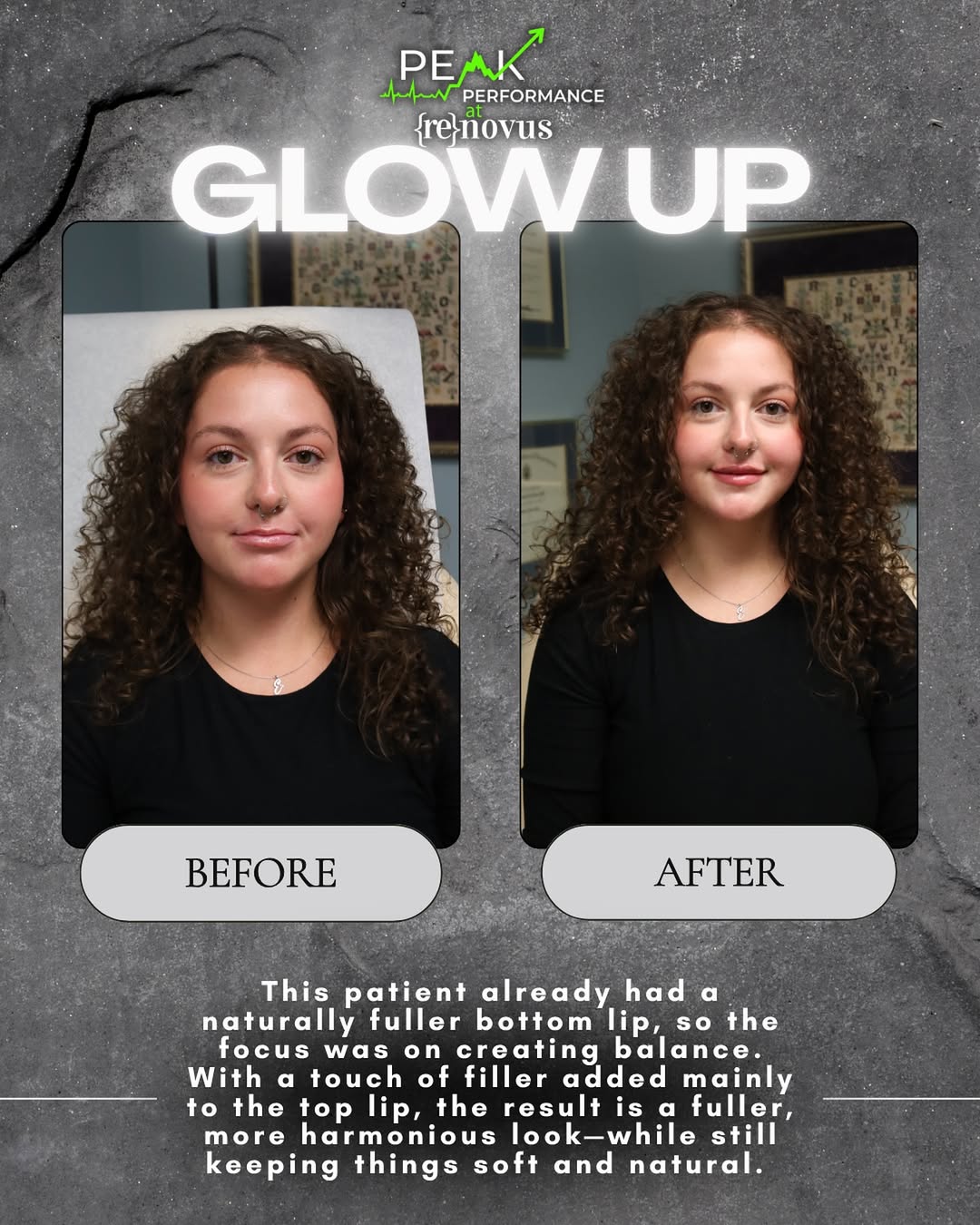 Before and after results of lip filler in Johnson City at Peak Performance. Subtle filler added to the top lip created a fuller, balanced, and natural look.