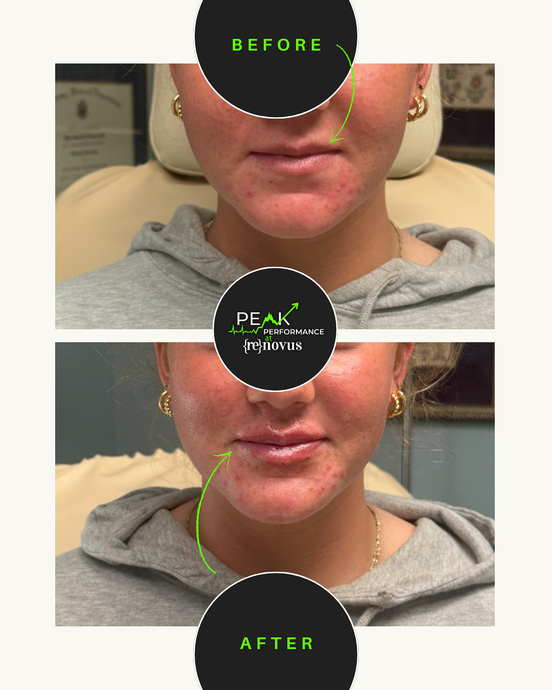 Before and after lip filler in Johnson City, TN at Peak Performance. Licensed professionals used FDA-approved fillers to create natural lip enhancement for patients across the Tri-Cities, including Kingsport and Bristol.