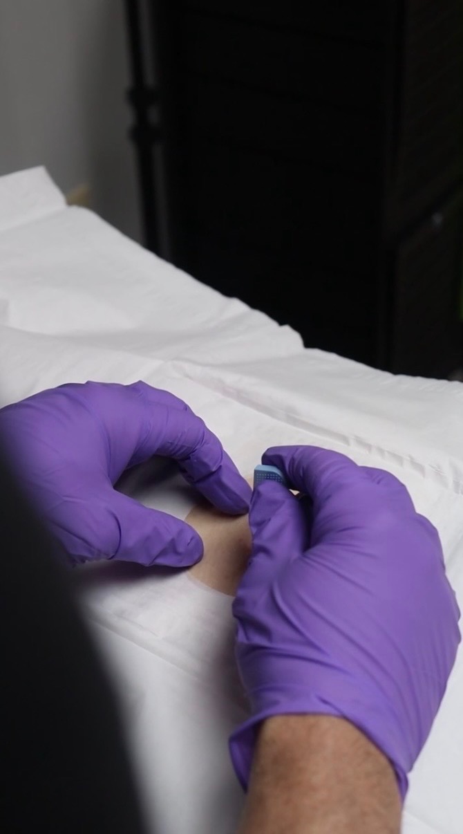 Medical provider inserting bioidentical hormone pellet for female patient at Peak Performance Wellness Johnson City