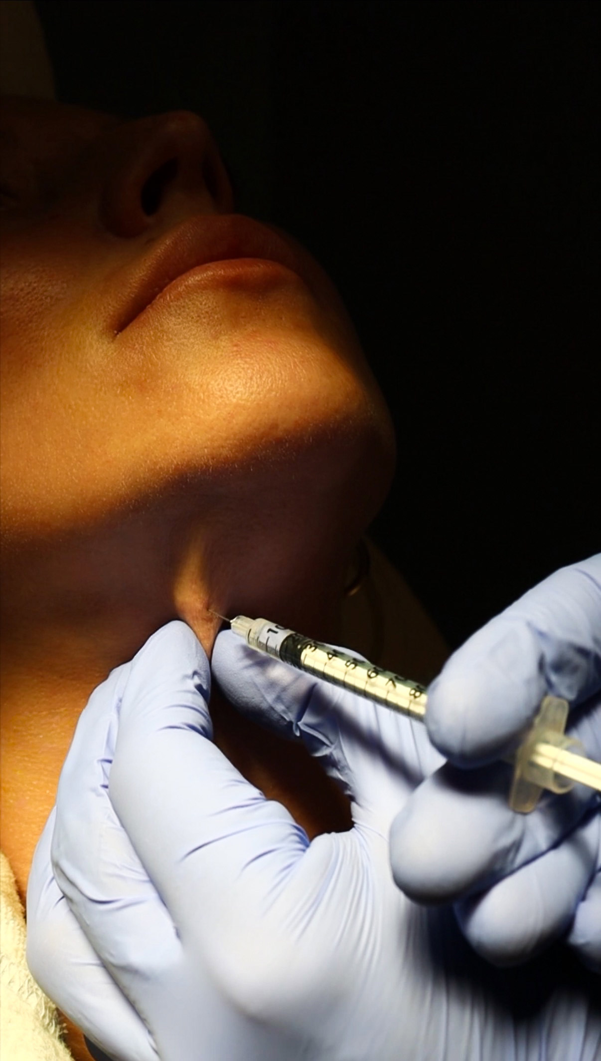 Cosmetic injection treatment along the chin and jawline at Peak Performance Wellness in Johnson City, TN